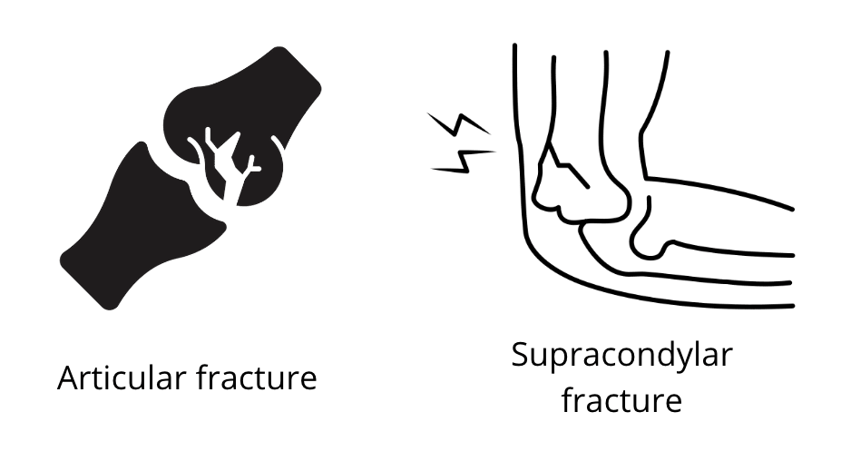 articular fracture and supracondylar fracture