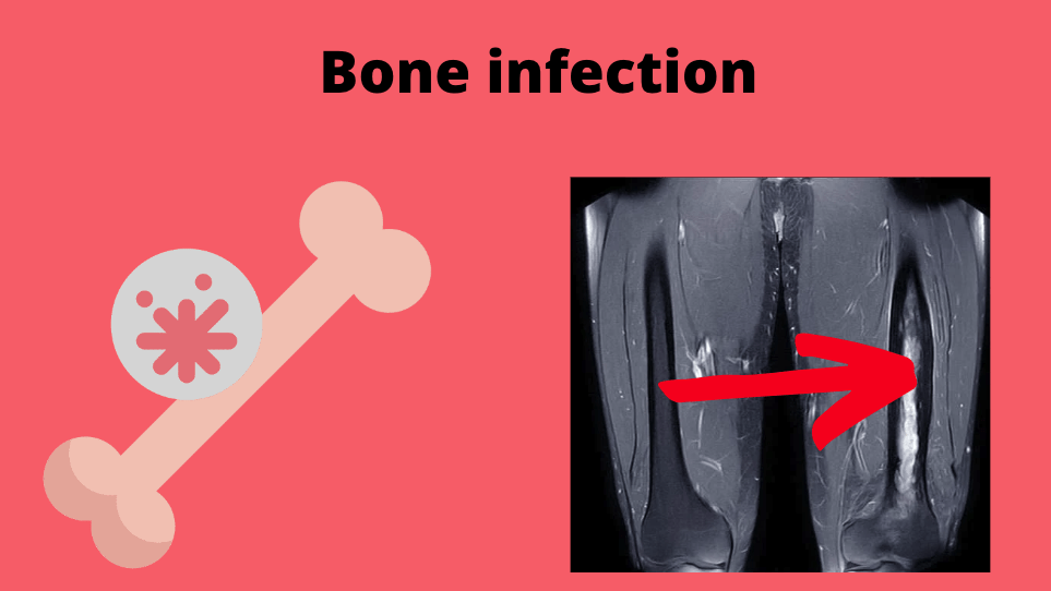 bone infection radiography
