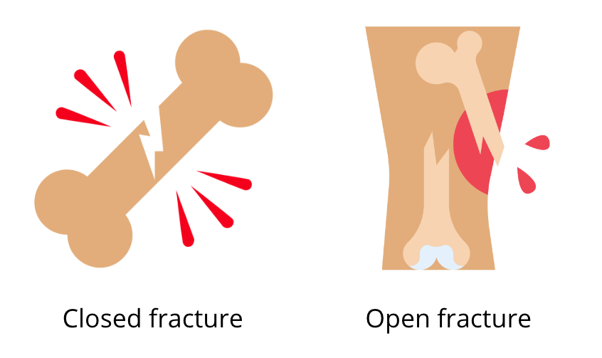 images about open and closed fractures