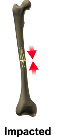 impacted-femoral-shaft-fracture
