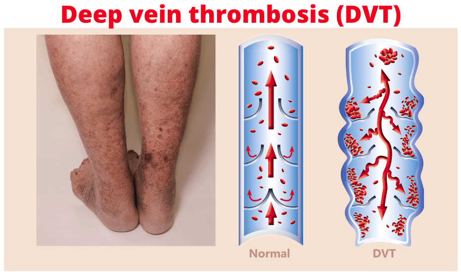 normal vein blood circulation and deep vein thrombosis (DVT)