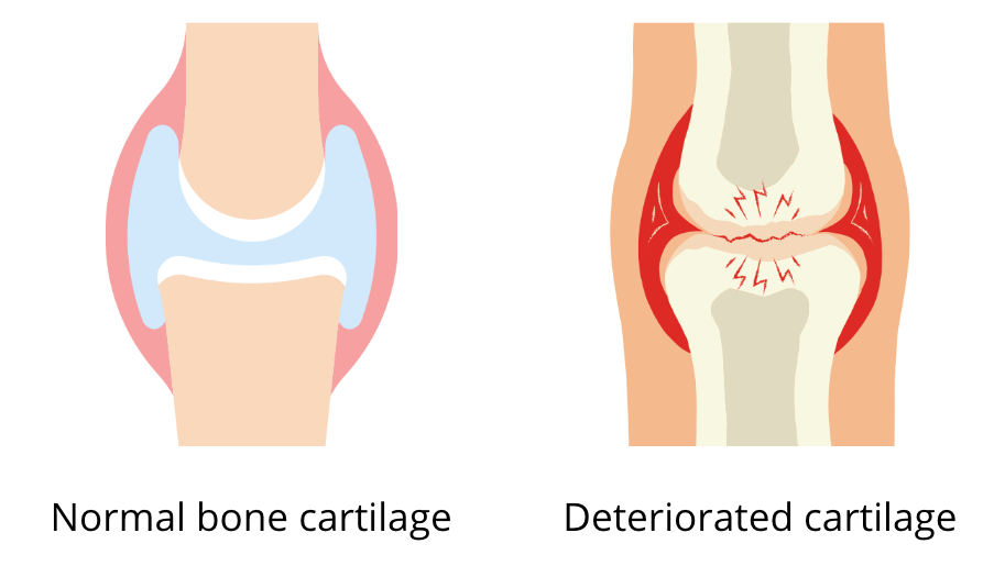 the photo on the left shows a perfectly healthy joint cartilage and the photo on the right a cartilage destroyed by arthrosis