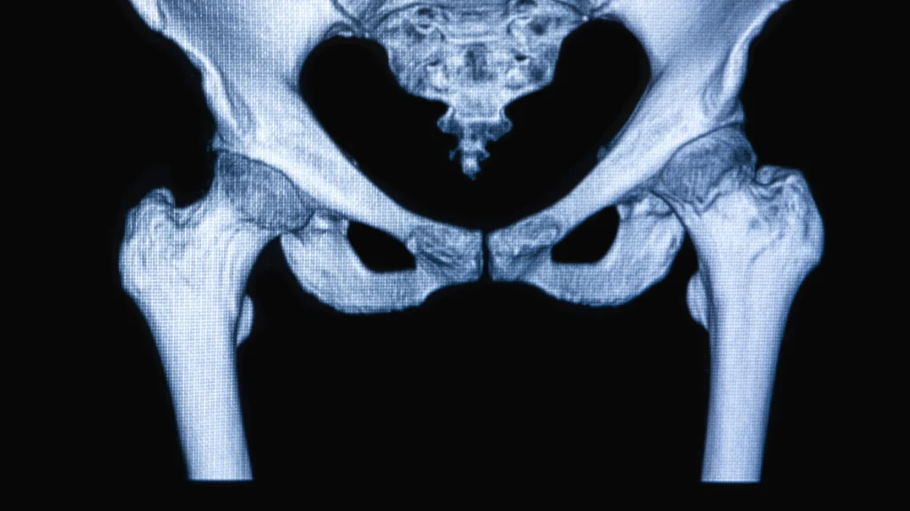 computed-tomography-of-hip-bones-and-joints-