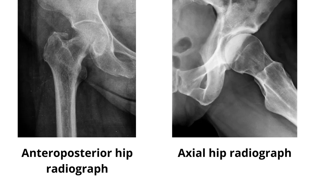 frontal and lateral projection of a hip ragiography