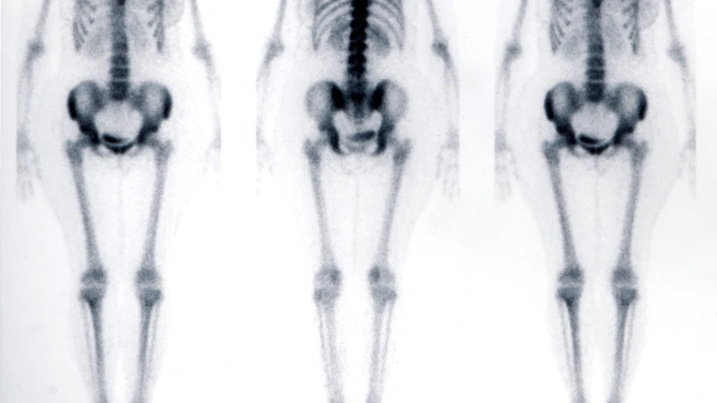 hip-joints-bone-scintigraphy