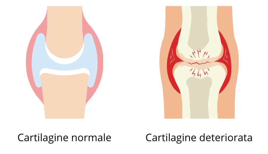 la foto a sinistra mostra una cartilagine articolare in perfetta salute e la foto a destra una cartilagine usurata dalla artrosi