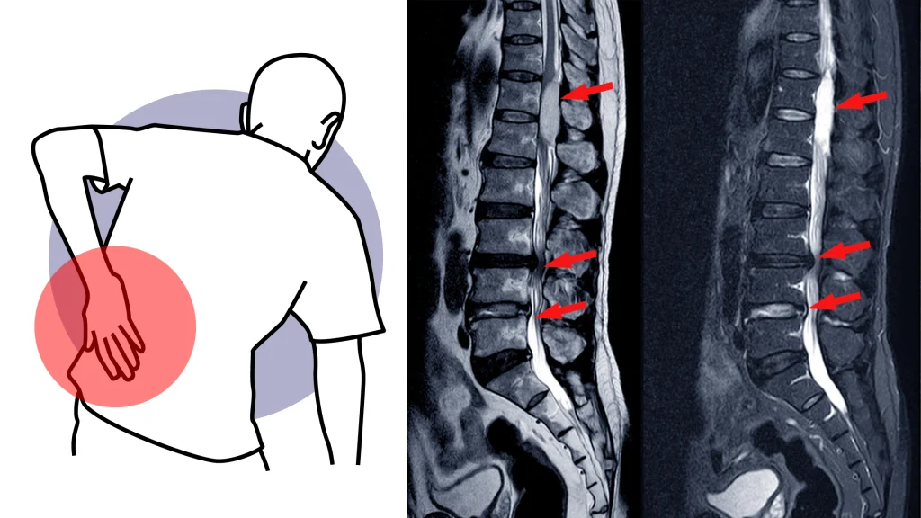 risonanza-magnetica-della-colonna-vertebrale-lombare-con-evidenza-di-prortusioni-ed-ernie