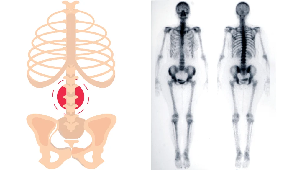 scintigrafia-ossea-del-corpo-umano-durante-le-indagini-di-fratture-ossee