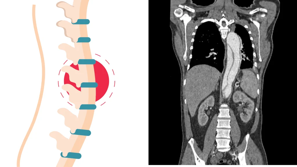 tomografia-computerizzata-della-colonna-vertebrale-lombare
