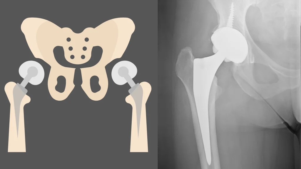 total hip replacement surgery and arthroplasty radiography