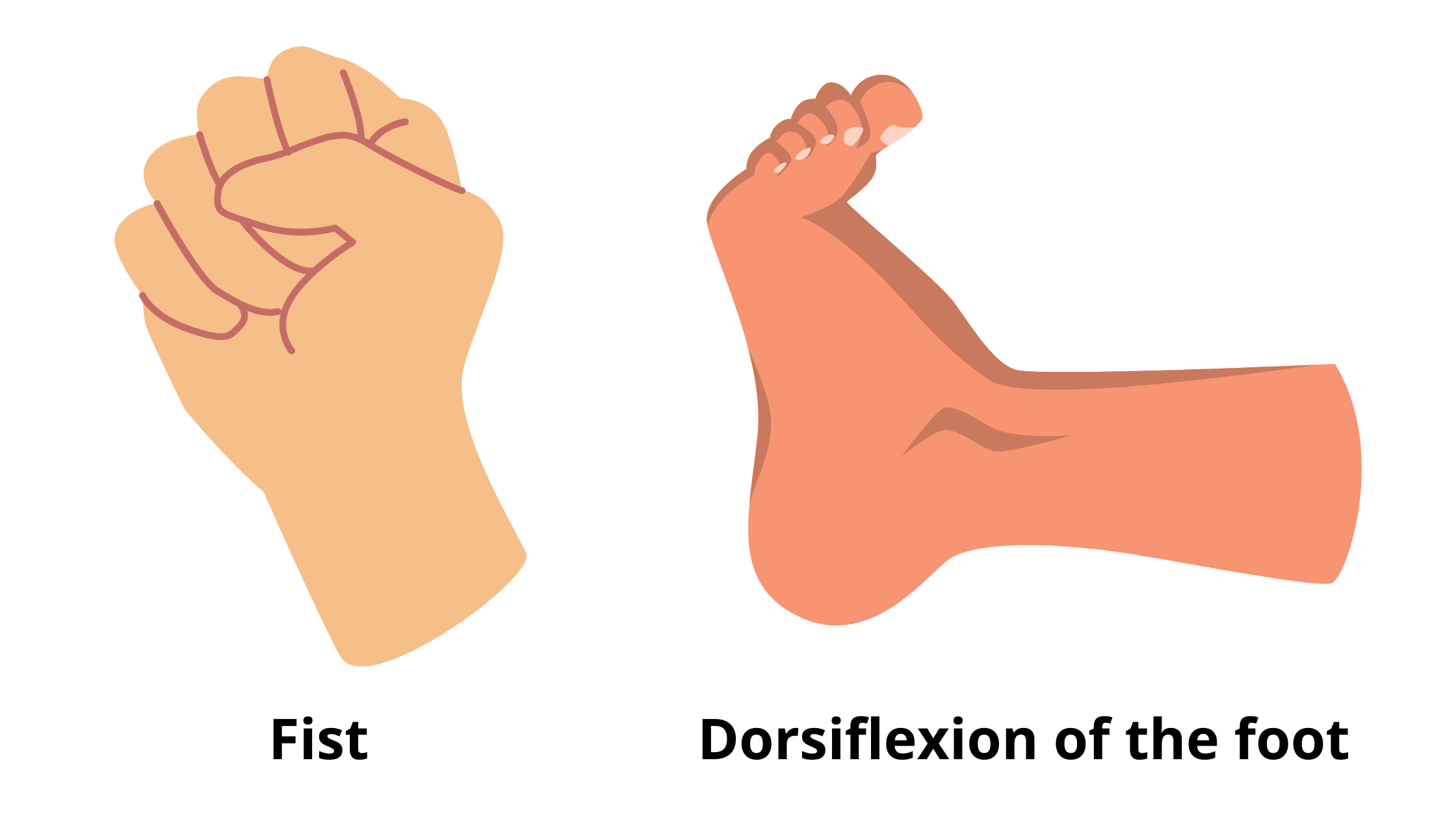 Inability to make a fist or to hammer toes and dorsiflexion of the foot