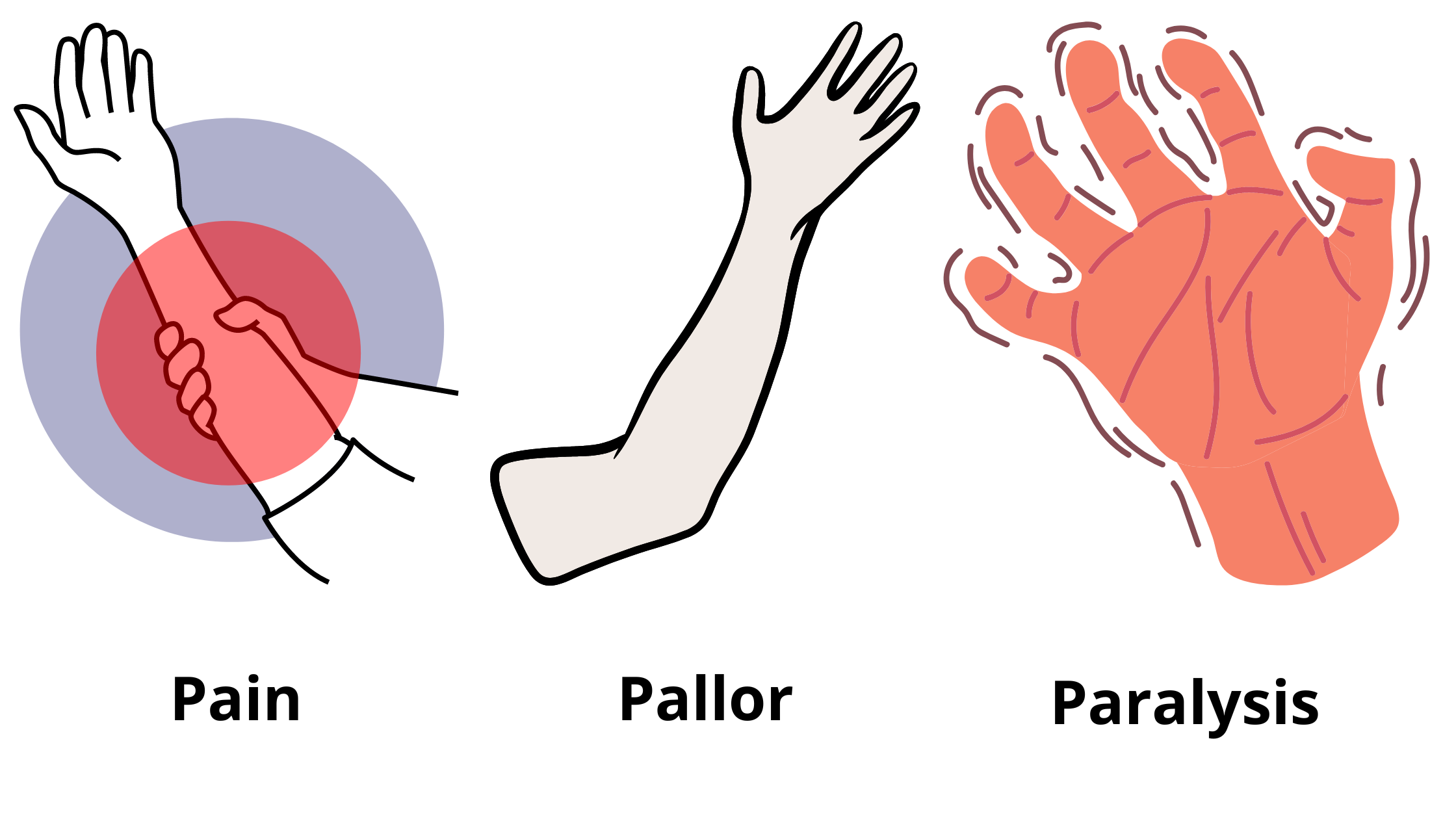The-five-P-syndrome-during-the-ischemic-Volkmann-contracture-characterized-by-pulselessness-pain