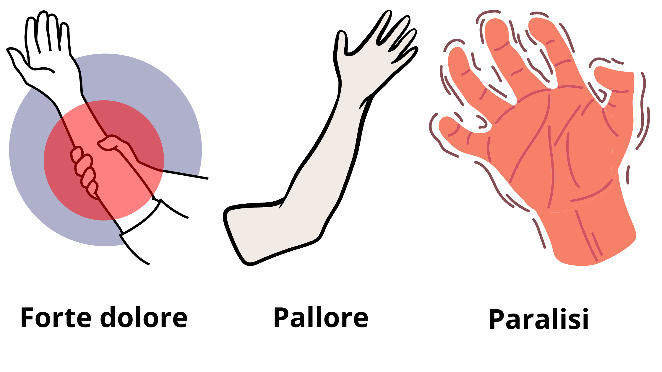 sindrome delle cinque P nella contrattura ischemica di Volkmann caratterizzata da assenza di polso, dolore, pallore, alterazione della sensibilità e paralisi