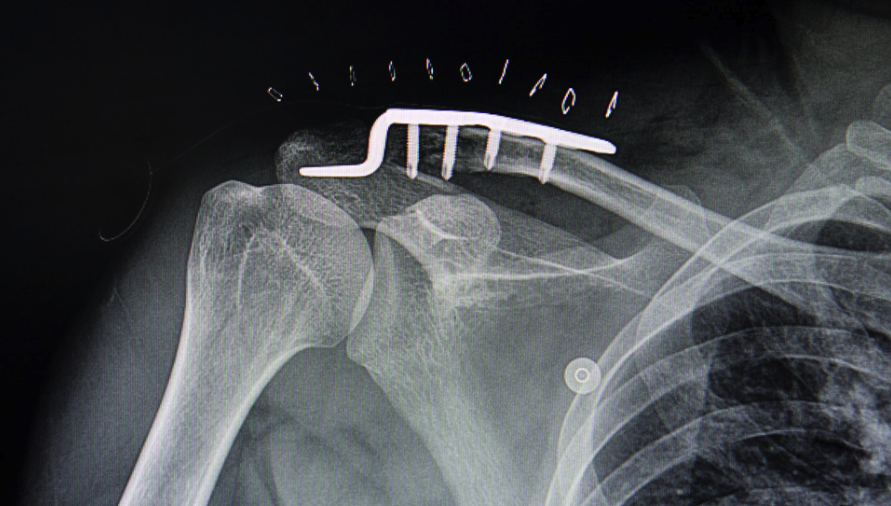clavicle fracture operation by osteosynthesis of bone fragments with plate and screws