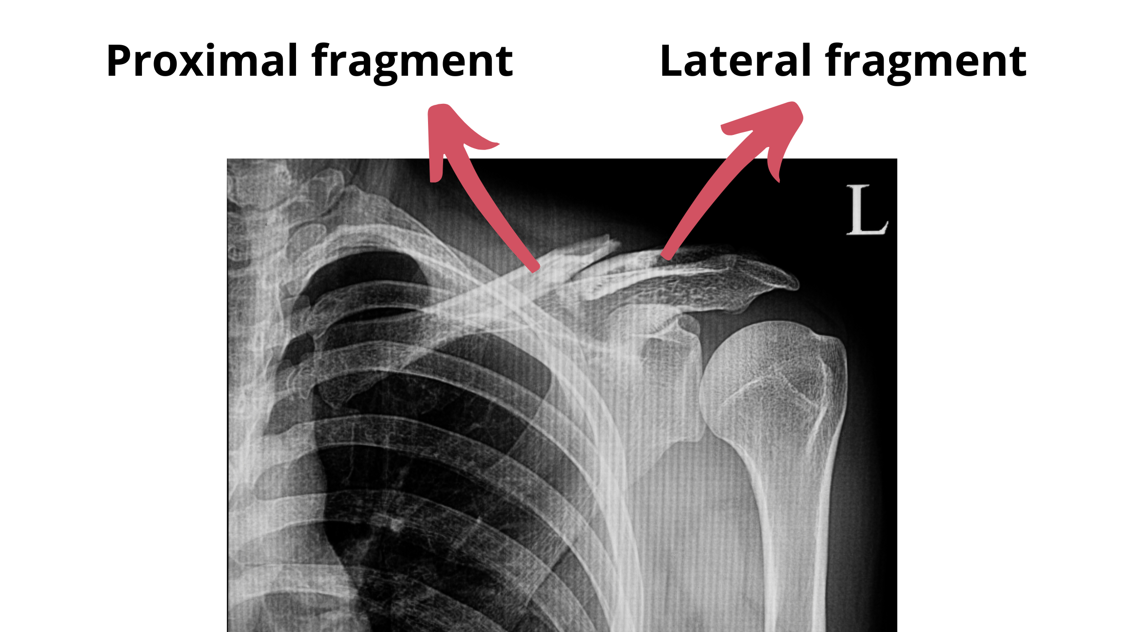 proximal-and-lateral-fragment-displacement-in-clavicle-fractures