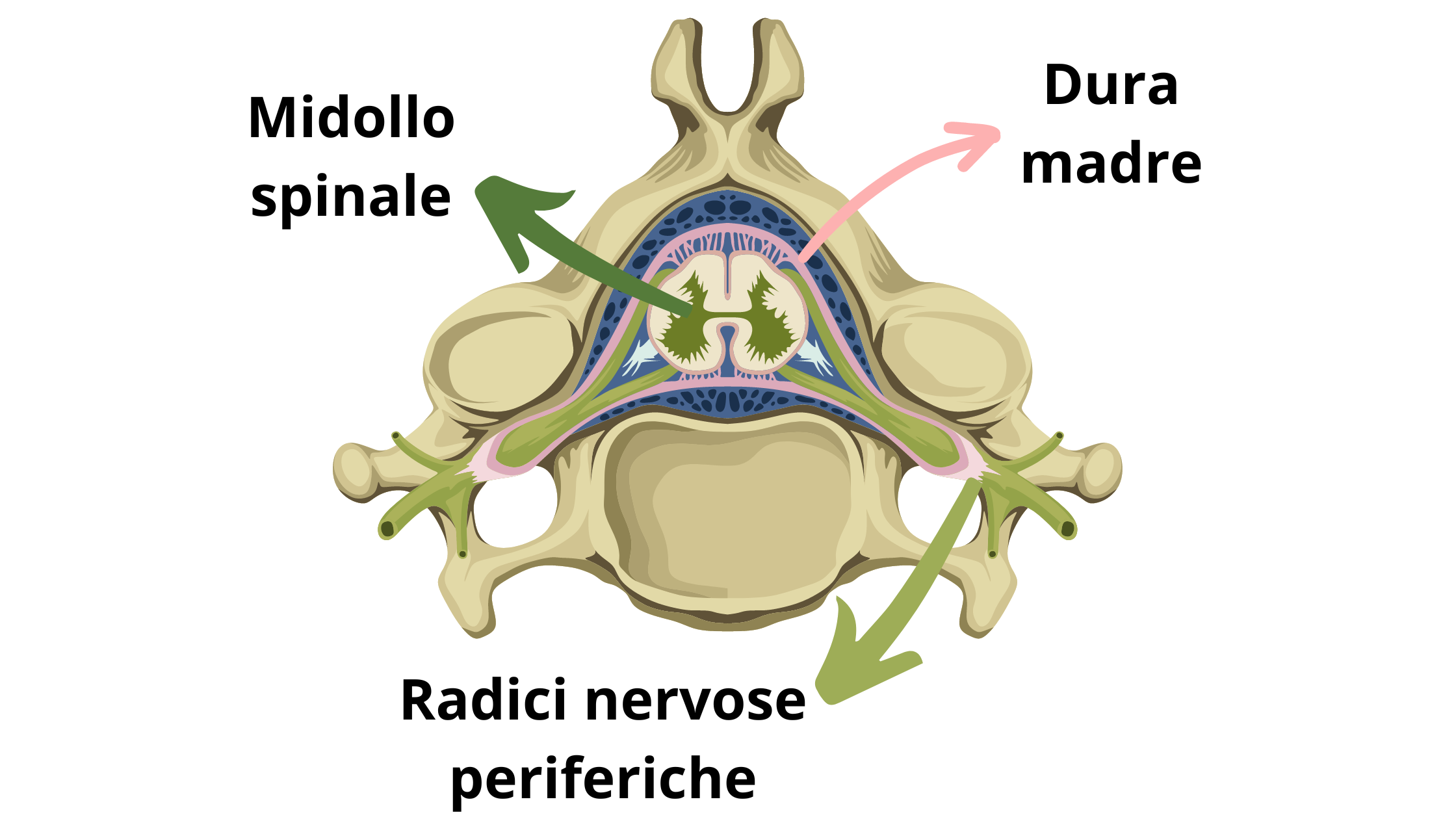 rappresentazione di una vertebra cervicale, con midollo spinale, dura madre e le radici nervose periferiche