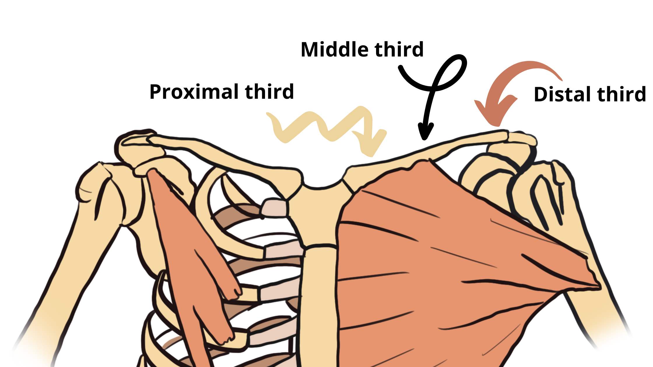 third-proximal-distal-and-middle-in-clavicle-fractures