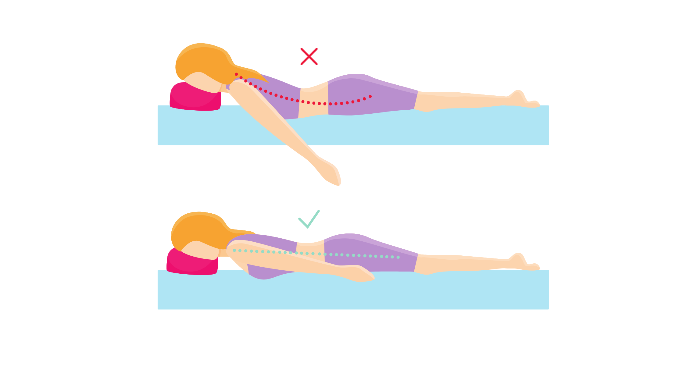 posizione prona nelle sindromi di spondilolistesi, da adottare con un cuscino tra il bacino e il basso ventre e un cuscino a ciambella per la testa