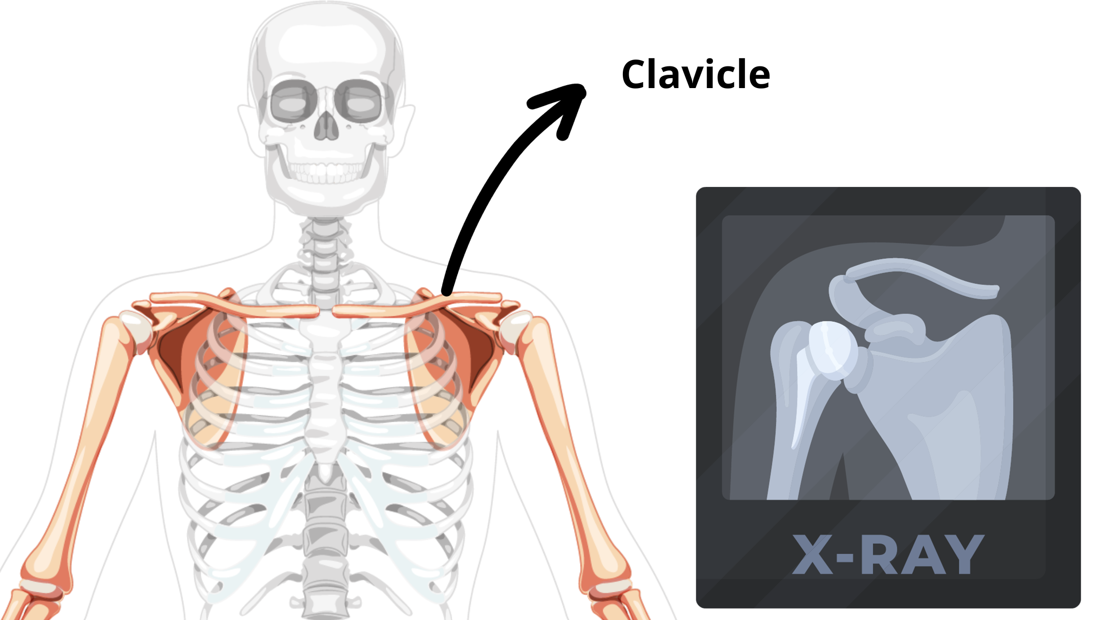 graphic-highlighting-the-skeletal-depiction-of-a-left-clavicle-and-a-radiography-of-a-right-clavicle
