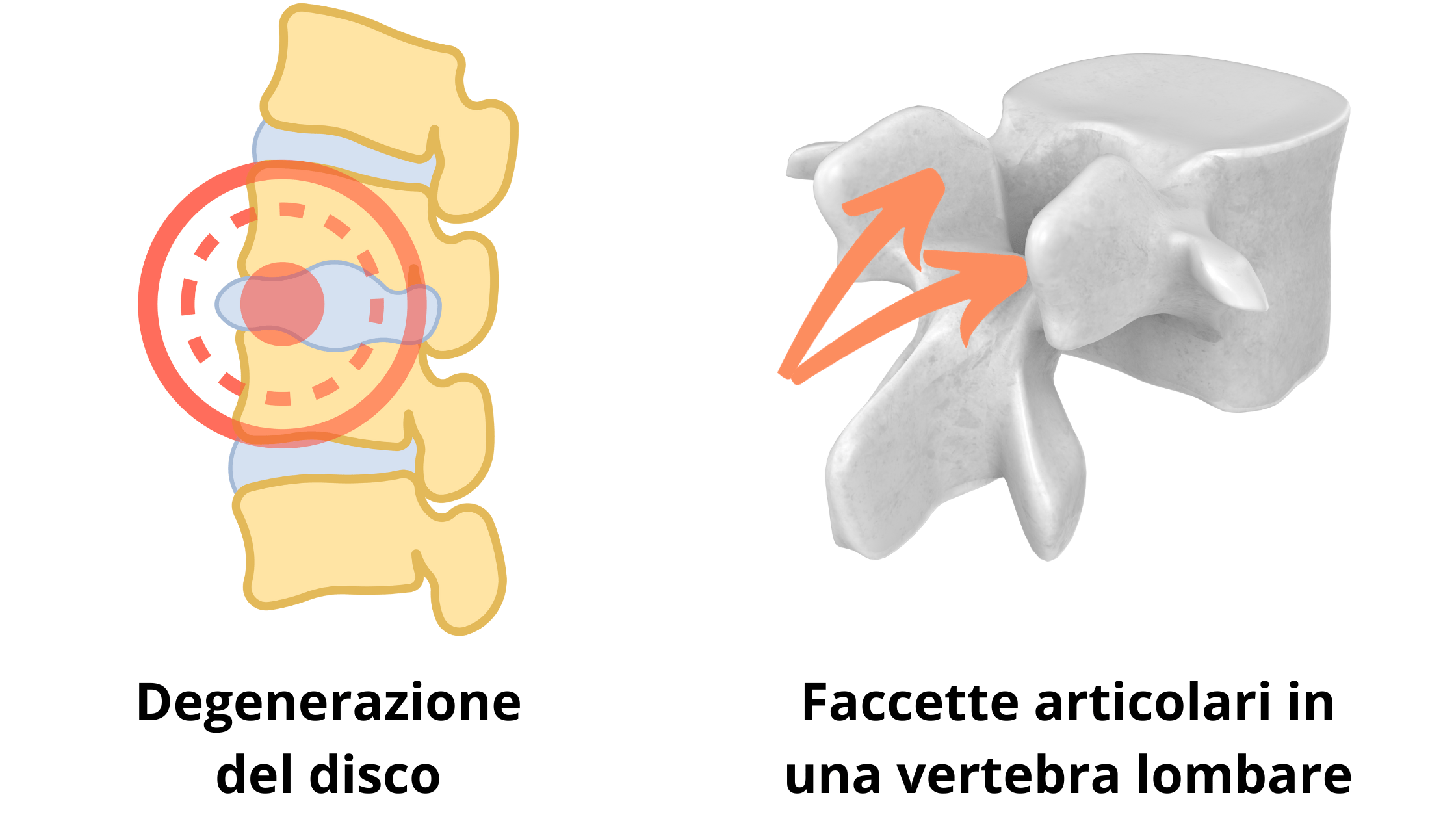 rappresentazione della degenerazione del disco intervertebrale dovuto all'instabilità dei segmenti ossei e le faccette articolari in una vertebra lombare