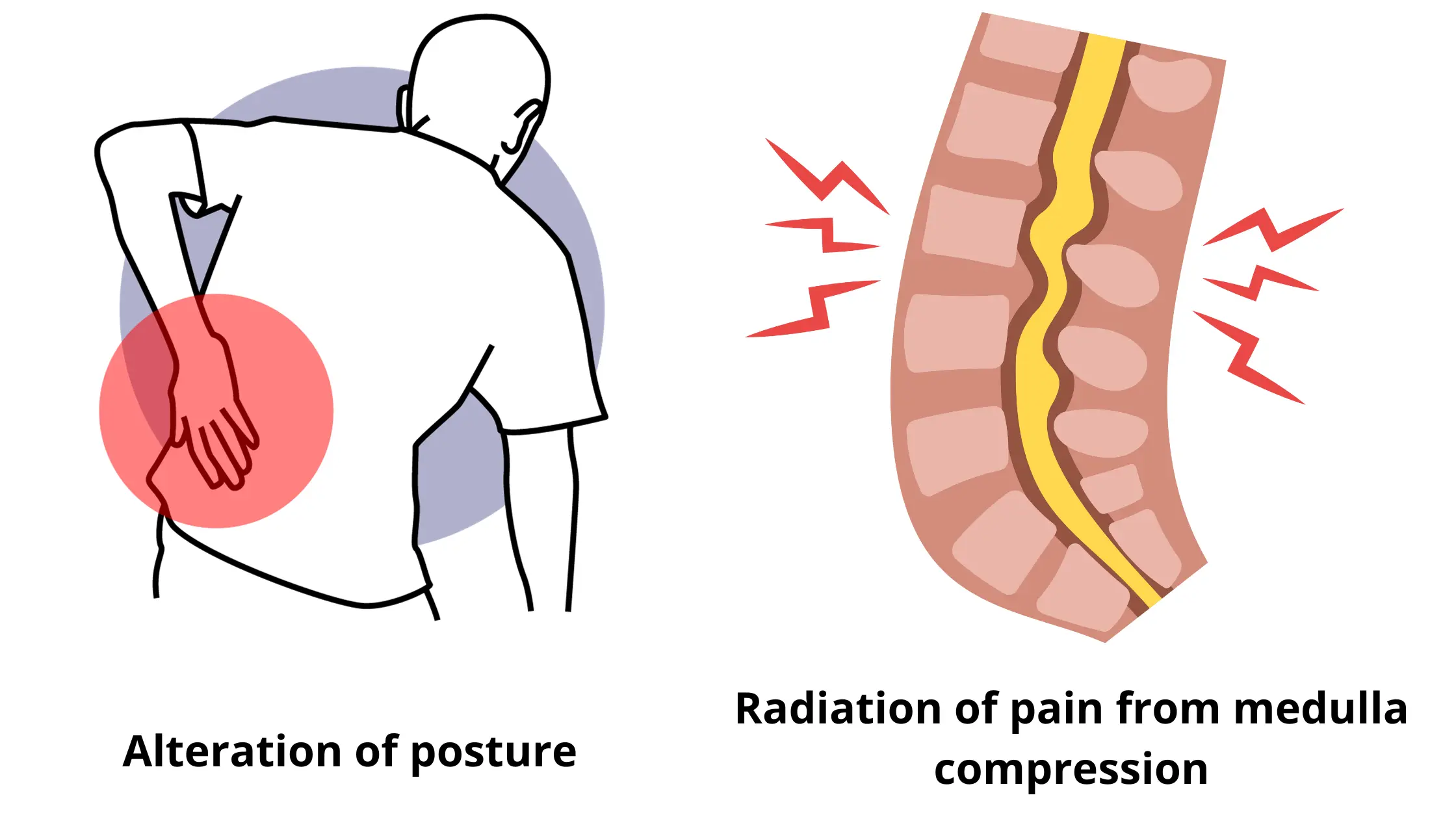 Alteration of posture and irradiation of pain from compression of the spinal cord among the symptoms of spondylolisthesis