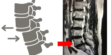 graphic-and-radiographic-image-of-a-vertebral-spondylolisthesis-of-the-L5-vertebra-on-S1